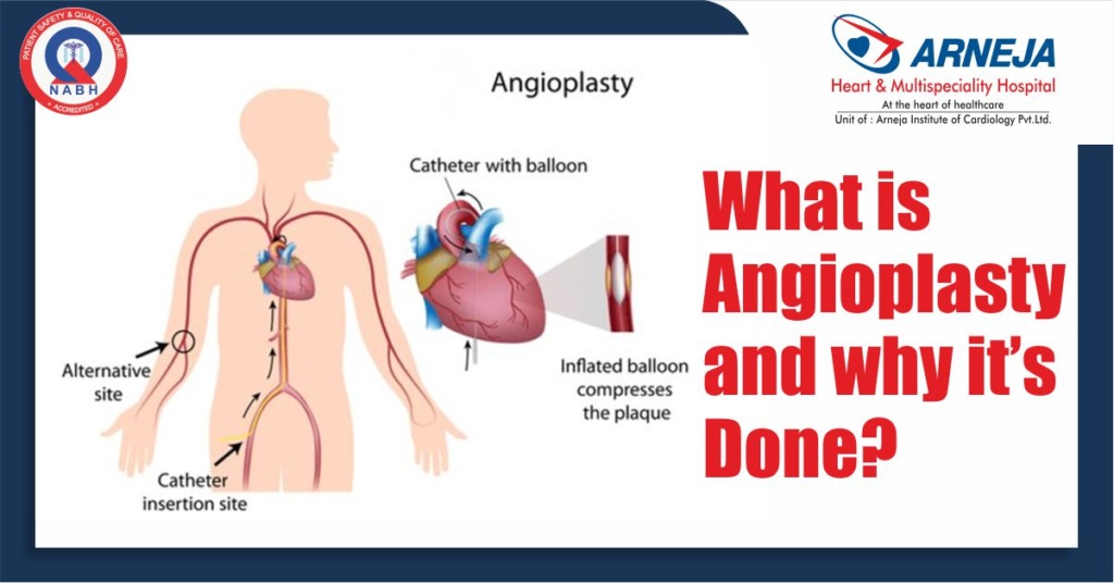 What is Angioplasty and Why it’s done