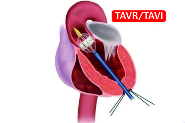 Arneja Hospital - TAVR/TAVI 