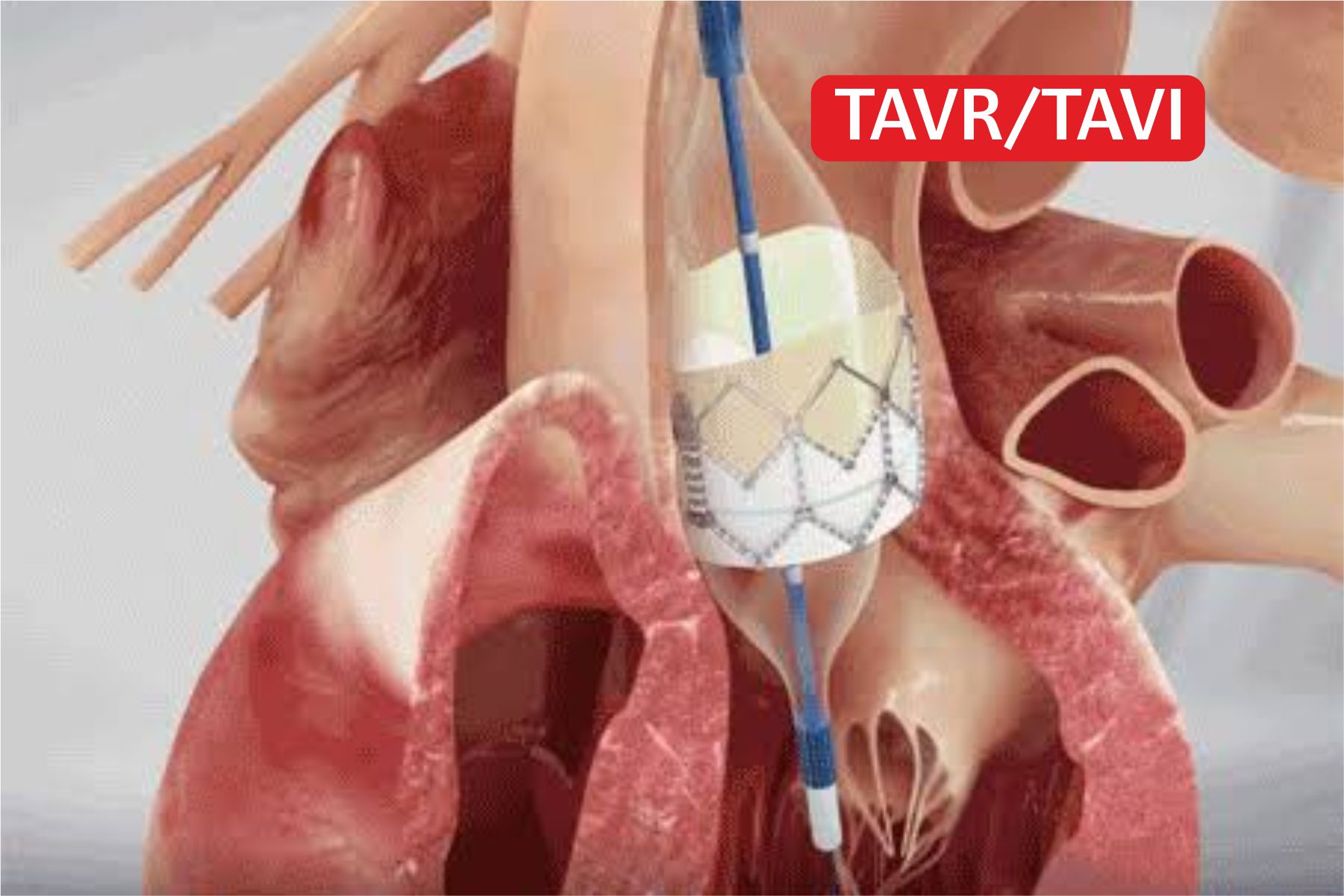 Arneja Hospital - TAVR/TAVI 