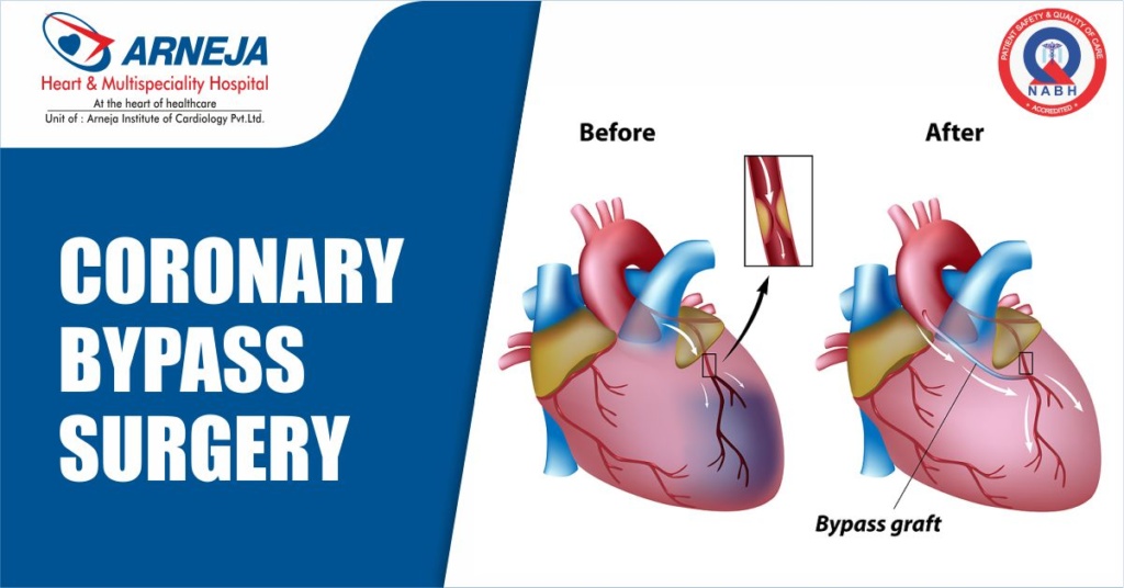 Know About Coronary Bypass Surgery
