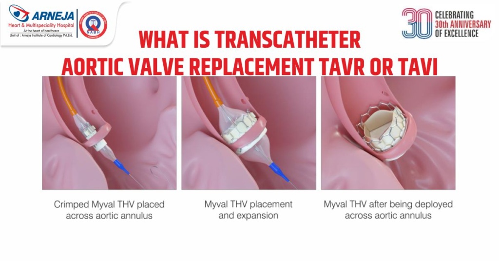 What is Transcatheter Aortic Valve Replacement TAVR OR TAVI?