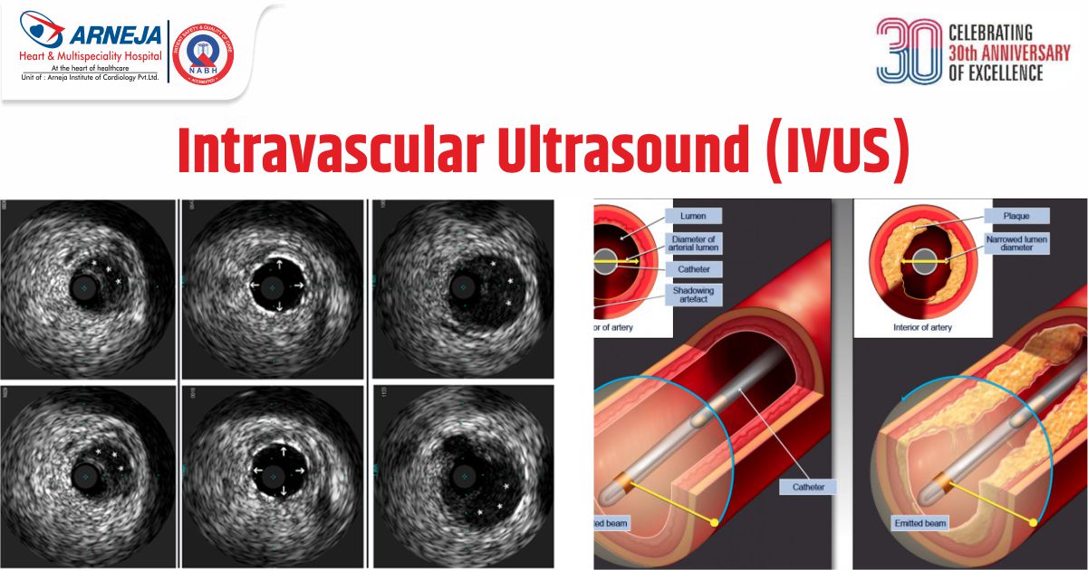 Arneja Heart Institute - Intravascular Ultrasound (IVUS)
